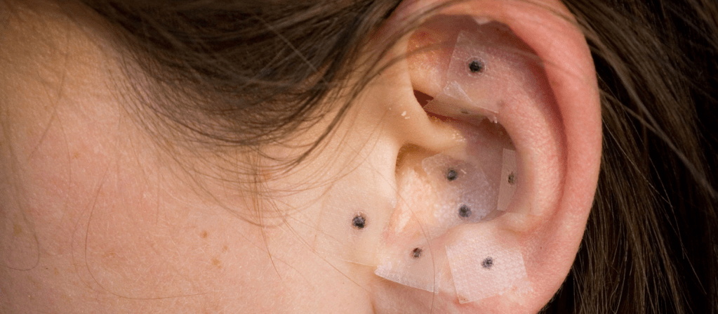 image of ear seeds applied to someone's ear